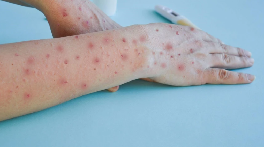 Monkey Pox: Hospitals in Delhi Offering MPOX Treatment and Prevention Tips