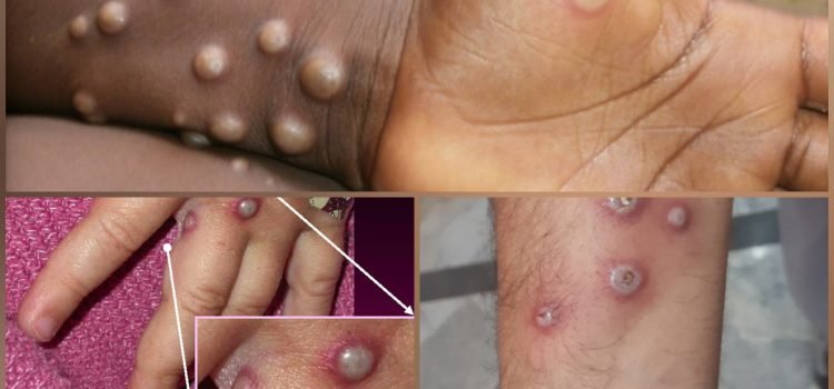 Monkey Pox