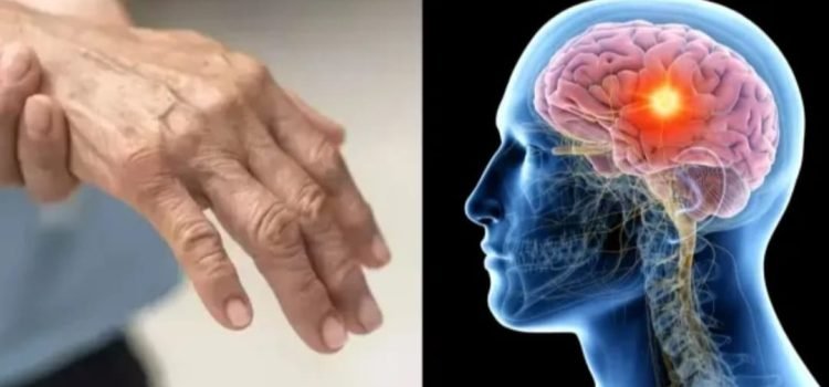Guillain-Barré Syndrome (GBS) Outbreak in Maharashtra: 1 Death, Over 100 Active Cases; Symptoms and Treatment Explained
